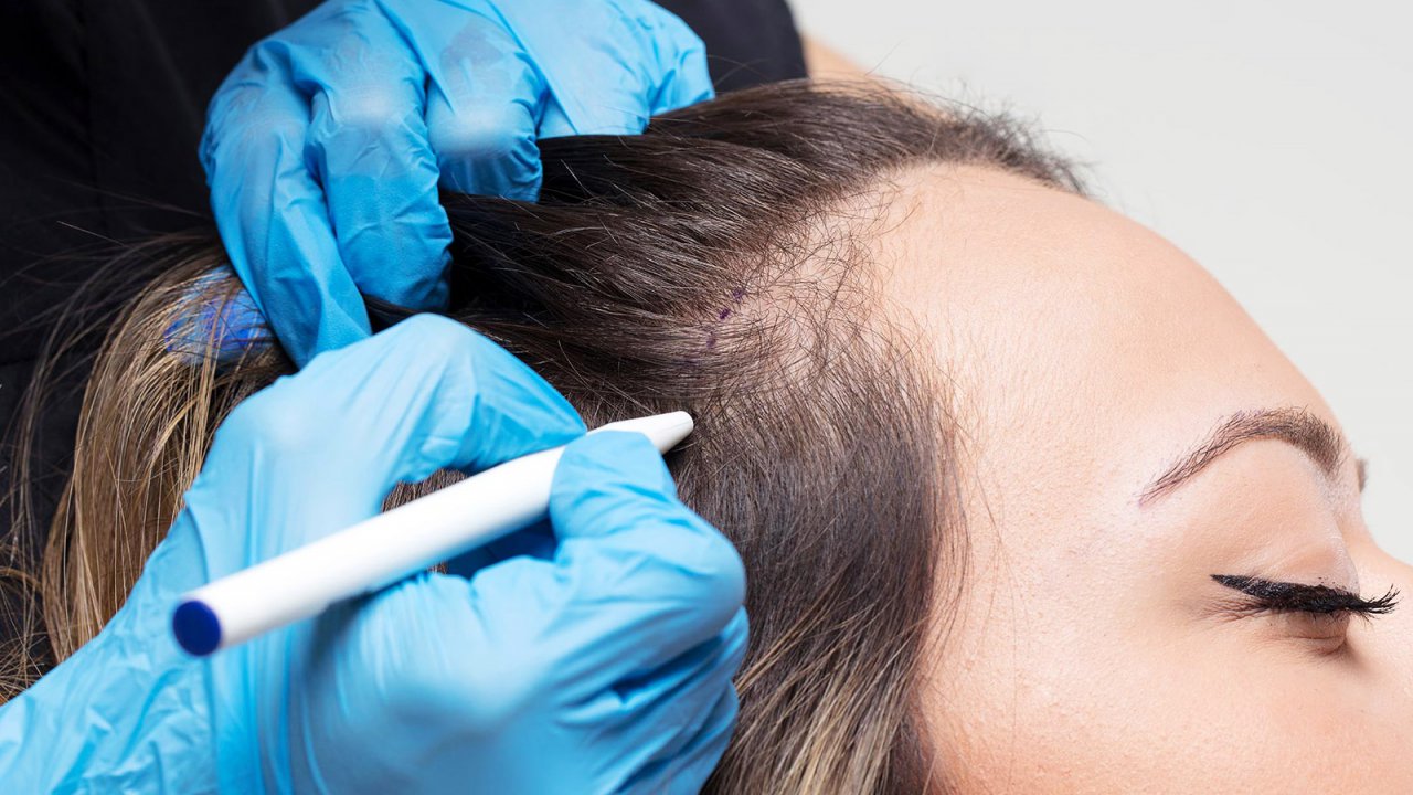 hair-transplantation-for-women