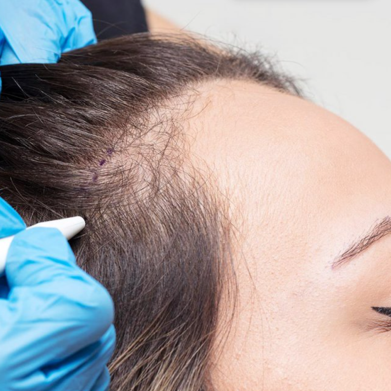 hair-transplantation-for-women.jpg
